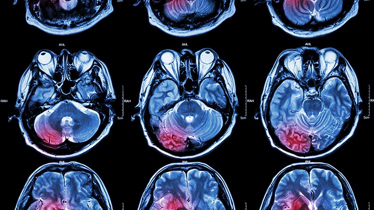 Medical negligence brain injury